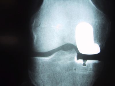 DePuy UKA (Implant 26)